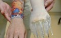 Prosthetic (Artificial) Arms